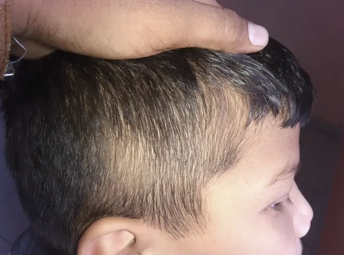Alopecia Areata case 6 after treatment